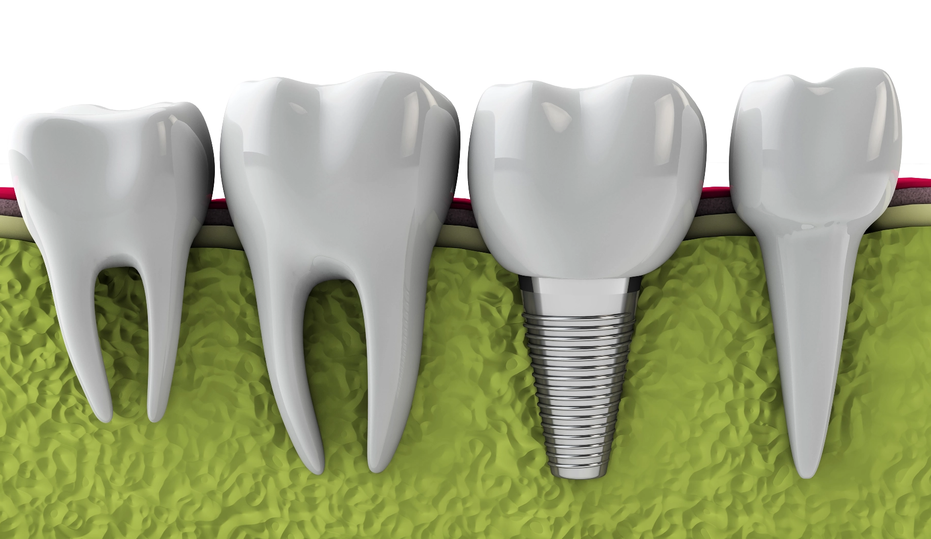 benefits-of-dental-implants